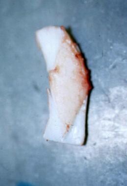 Rib graft for reconstruction of subglottic stenosi