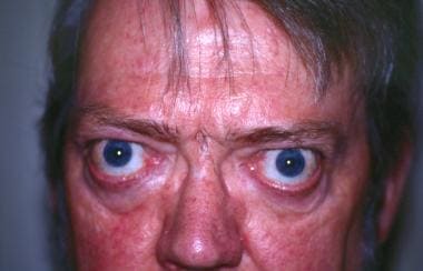Long-standing thyroid ophthalmopathy with typical 