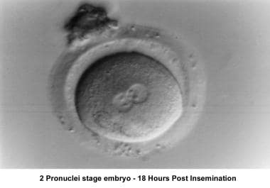 Infertility. Two-pronuclei stage embryo - Eighteen