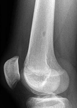 Oblique (45°) radiograph of the distal femur best 