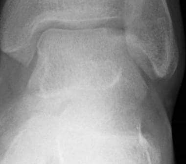 Stage 2A osteochondral fracture of the lateral tal