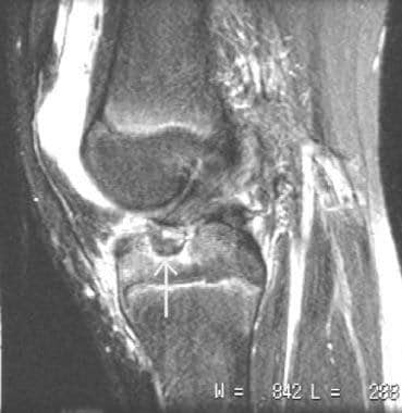 ACL insufficiency in a pediatric patient secondary