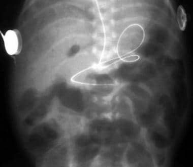 The radiograph demonstrates multiple dilated loops