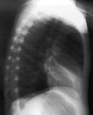 Lateral view chest radiograph showing a wedge-shap