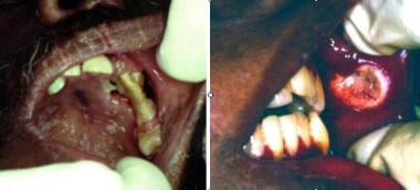 Cryptococcosis. Left image shows solitary, destruc