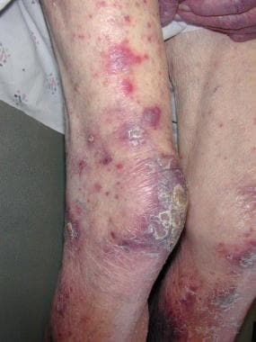 A patient with typical plum-colored lesions seen i