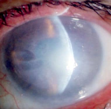 The left eye of a 75-year-old man showing fully de
