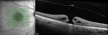 SD-OCT Image of a stage 2 full thickness macular h