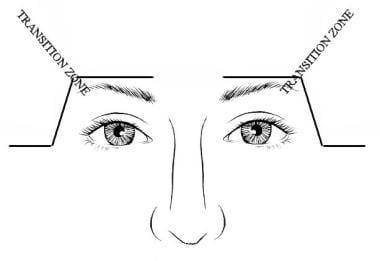 Selective elevation of lateral brow can be accompl