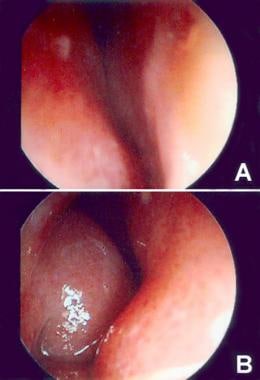 (A) Endoscopic view of left nares showing caudal s