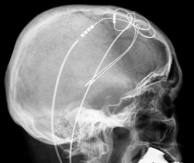 Parkinsons Disease Progression >> Parkinson Disease Differential Diagnoses Parkinsons Disease Progression >> Parkinson Disease Differential Diagnoses