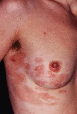 What is lymphoma of the skin?