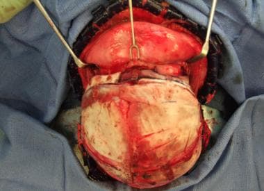 Unilateral coronal craniosynostosis repair. Comple