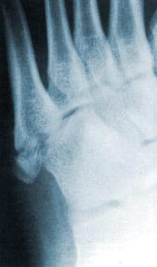 Radiograph of the left foot. This image depicts a 