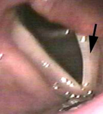 Preoperatively, the arrow demonstrates the paralyz