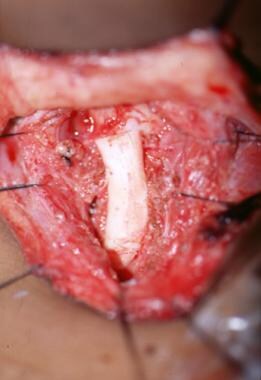 An intraoperative aerial view of an anterior carti