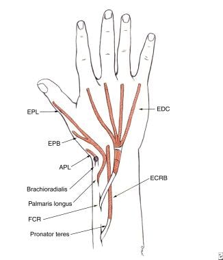 Tendon transfer for high radial nerve palsy. The p