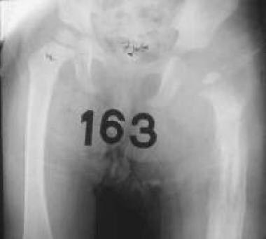 Fourth radiograph in series of septic left hip. Se