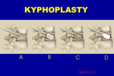 In kyphoplasty, a KyphX inflatable bone tamp is pe