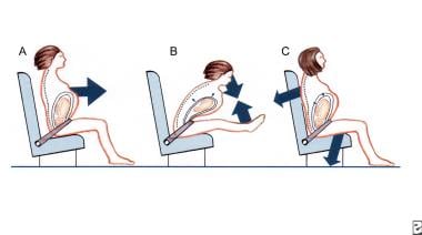 Correct use of seat belts in pregnancy. 