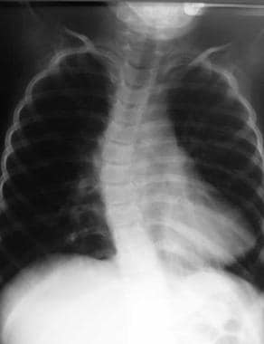 Chest radiograph from 4-year-old boy with Werdnig-