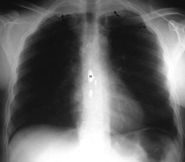 Chest radiograph in a 56-year-old man with NF1 sho