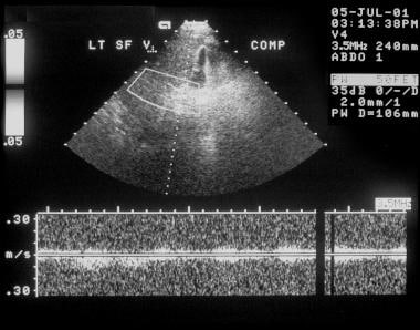 Duplex spectral Doppler sonogram of the portal vei