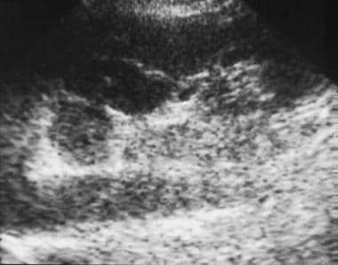 Ultrasonogram of an adrenal mass. Oblique sagittal