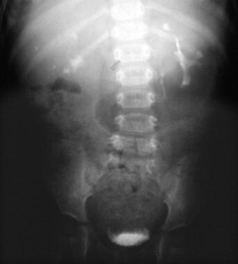 Intravenous urogram in a 3-year-old child. This im
