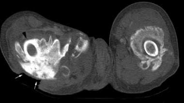 Noncontrast, axial computed tomography (CT) scan t