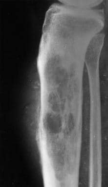 A 57-year-old woman with knee pain. Lateral radiog