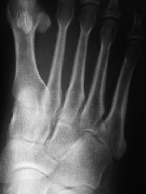 Fractured metatarsals. Image shows a thin layer of