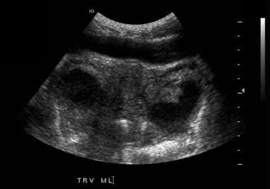 Transabdominal ultrasound scan. This image demonst