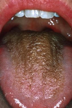 Brown hairy tongue in a middle-aged woman who drin