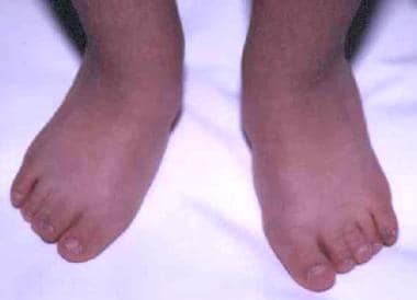 Case study 1. Small feet with short hypoplastic to