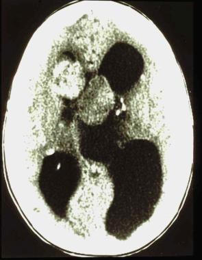 Hydrocephalus from a subependymal giant cell astro