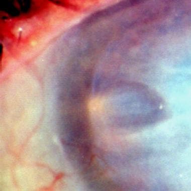 Close-up view of the limbal area of the same patie