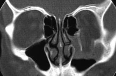 Coronal CT scan of orbits demonstrating loss of or