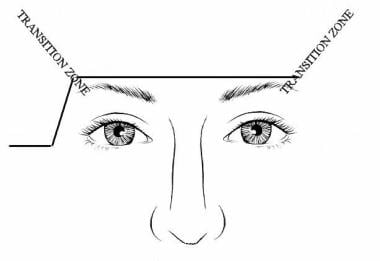 Elevating one brow more than the other requires an