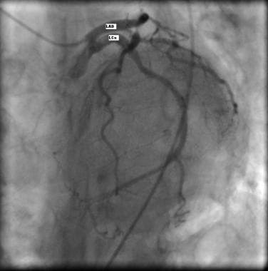Coronary angiography showing separate origin of th
