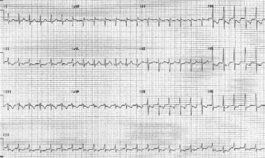 Atrial tachycardia. The patient's heart rate is 15