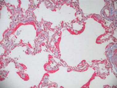 Photomicrograph showing delayed stage (proliferati