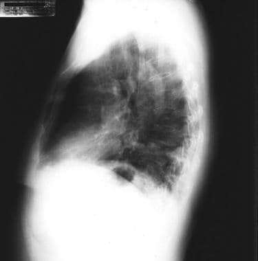 Lateral radiograph showing a left lower lobe arter