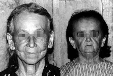 A 50-year-old woman with GHRD (right) and her 75-y