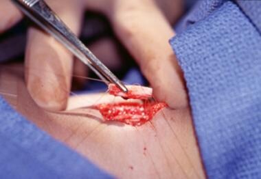 An intraoperative side view of the neck with carti