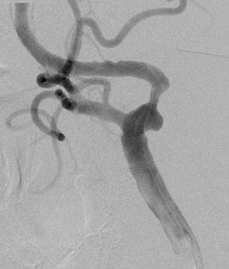 Precarotid stent angiogram. A moderately high grad