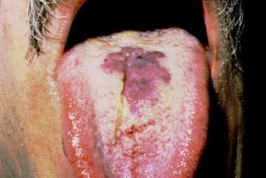 Oral Kaposi sarcoma in a patient with AIDS. Note t
