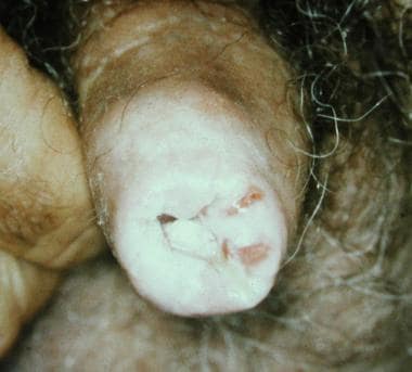 Squamous cell carcinoma arising on genital lichen 