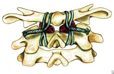 Rheumatoid spondylitis. Brooks-type fusion. Rectan