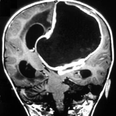Case 3a. Anaplastic ependymoma of the lateral vent